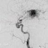 Angiographie Angiographie