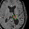 MRT-Aufnahme Gammaknife Behandlung