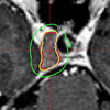 Gamma Knife Behandlung