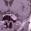 Gamma Knife Behandlung Gamma Knife Behandlung