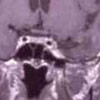 12 Wo. nach Gamma Knife Behandlung 12 Wo. nach Gamma Knife Behandlung