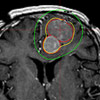 Gamma Knife Behandlung