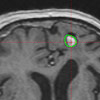 3 Mo. nach Gamma Knife Behandlung