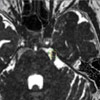 Gamma Knife Behandlung