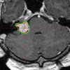 Akustikus Neurinom bei Behandlung Akustikus Neurinom bei Behandlung