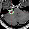 6 Monate nach der Gamma Knife Behandlung