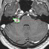 20 Monate nach der Gamma Knife Behandlung 20 Monate nach der Gamma Knife Behandlung