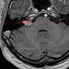 32 Monate nach der Gamma Knife Behandlung 32 Monate nach der Gamma Knife Behandlung
